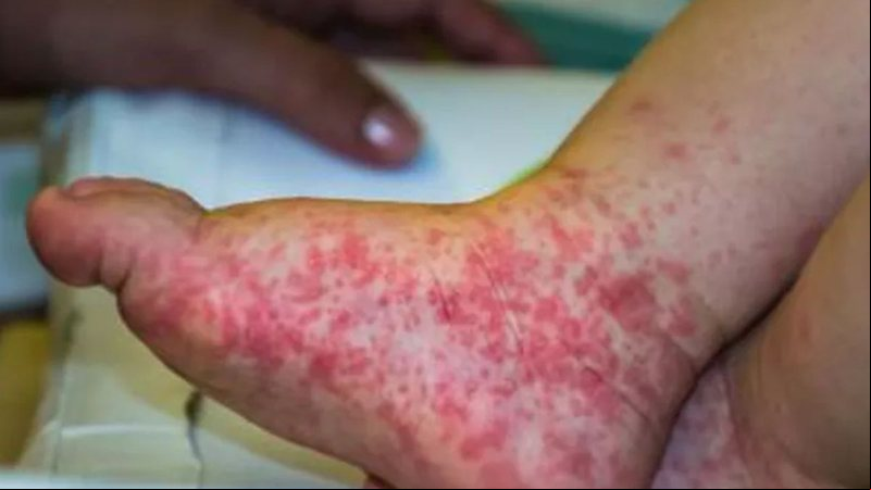 Gripe do tomate: Conheça os sintomas da doença surgida na Índia